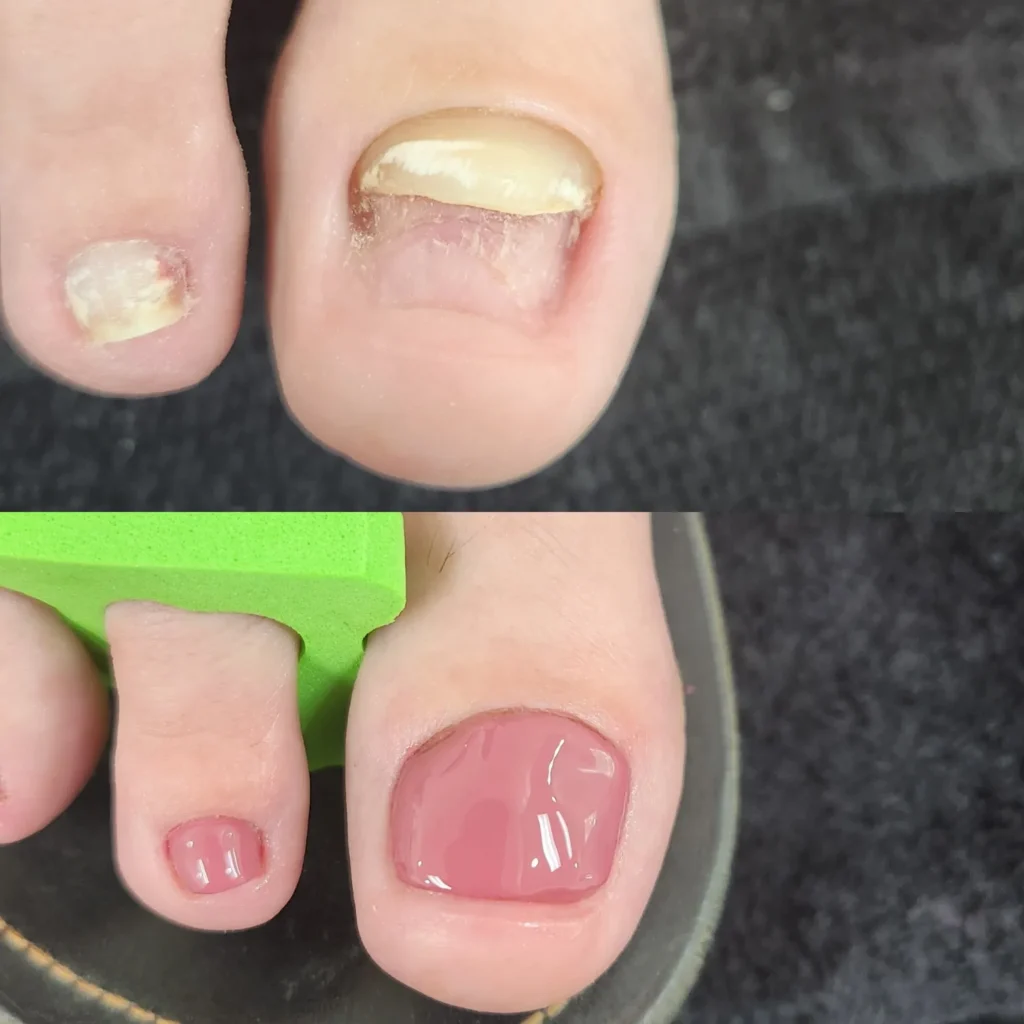 toenail restoration